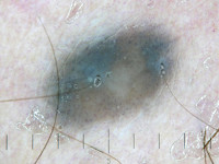Blue nevus