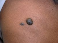 Blue rubber bleb nevus syndroom