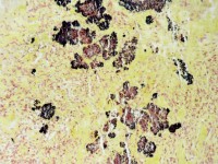 Botryomycosis