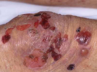 Bulleus pemphigoid