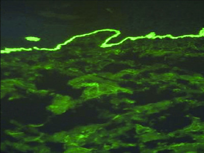 IF bullous pemphigoid