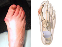 Bunion