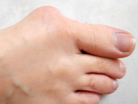 Bunion