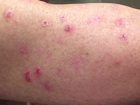Sabra dermatitis