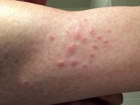 Sabra dermatitis