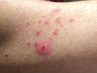Sabra dermatitis