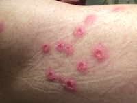 Sabra dermatitis