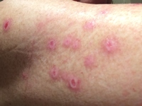 Sabra dermatitis