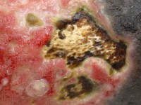 Calcinosis cutis bij chronische veneuze insufficientie