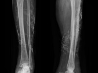 Calcinosis cutis bij chronische veneuze insufficientie