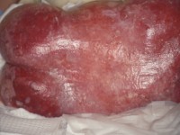 Calcinosis cutis bij epidermolysis bullosa dystrofica