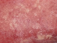 Calcinosis cutis bij epidermolysis bullosa dystrofica