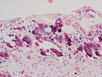 Calcinosis cutis bij epidermolysis bullosa dystrofica