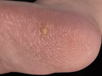 Calcinosis cutis na hielprik