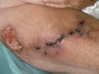 Calciphylaxis cutis bij nierinsufficiëntie en secundaire hyperparathyreoïdie