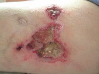 Calciphylaxis cutis bij nierinsufficiëntie en secundaire hyperparathyreoïdie