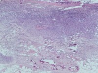 Calciphylaxis cutis bij nierinsufficiëntie en secundaire hyperparathyreoïdie