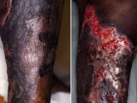 Calciphylaxis cutis bij nierinsufficiëntie en secundaire hyperparathyreoïdie