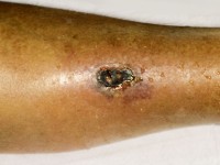 Calciphylaxis cutis bij nierinsufficiëntie en secundaire hyperparathyreoïdie