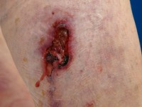 Atypical calciphylaxis