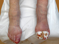 Atypical calciphylaxis