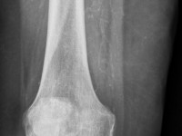 Atypical calciphylaxis