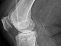 Atypical calciphylaxis