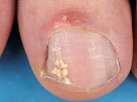 Candida paronychia en onychomycose