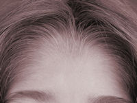 Congenitale hypertrichosis