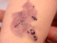 Capillair-lymfatische malformatie