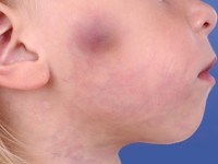 Capillair-veneuze malformatie