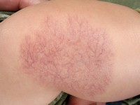 Capillaire malformatie