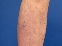 Capillaire malformatie