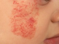 Capillaire malformatie