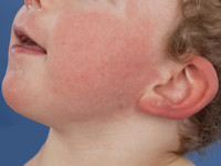 Cardiofaciocutaan syndroom