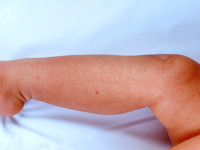 Cardiofaciocutaan syndroom