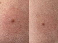 Cardiofaciocutaan syndroom