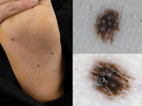 Cardiofaciocutaan syndroom