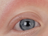 Cardiofaciocutaan syndroom