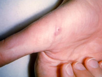 Cat scratch disease, lymphoreticulosis benigna