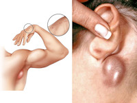 Cat scratch disease, lymphoreticulosis benigna