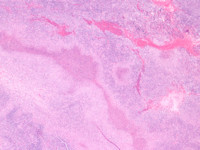 Cat scratch disease, lymphoreticulosis benigna