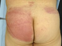 Cellulitis