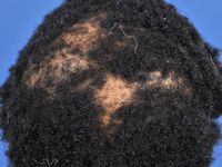 Central centrifugal cicatricial alopecia