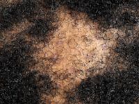 Central centrifugal cicatricial alopecia