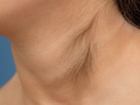 Cervicale hypertrichose