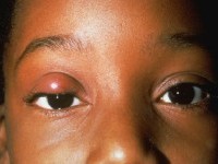 Chalazion