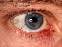 Chalazion