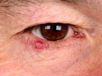 Chalazion