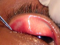 Verwijderen van een chalazion middels curettage